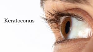 מחלת עיניים קרטוקונוס